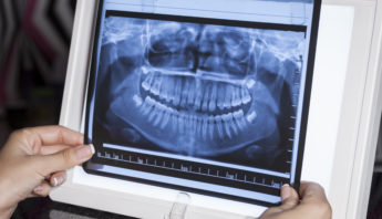 Panoramic X-ray for orthodontic treatments like Invisalign, at our City of London clinic.