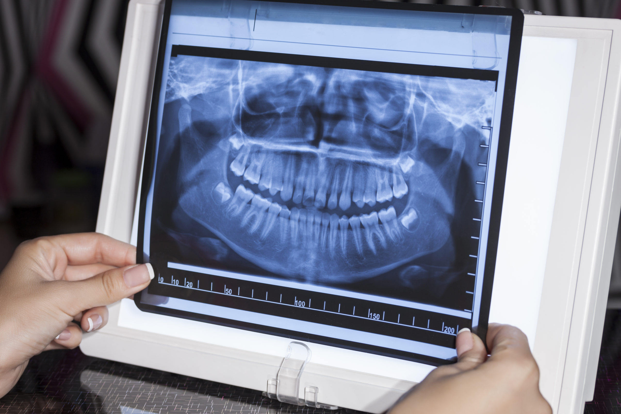 Panoramic X-ray for orthodontic treatments like Invisalign, at our City of London clinic.